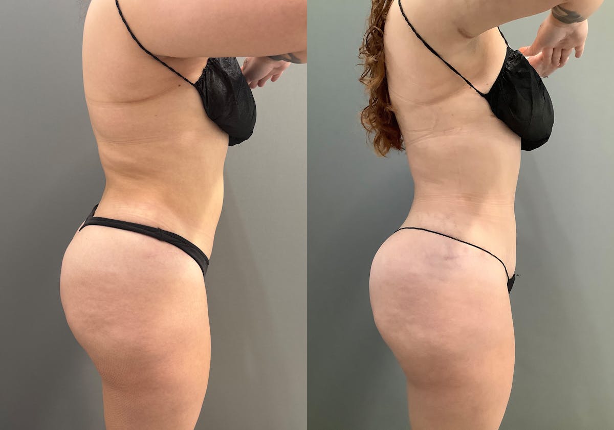 Liposuction Before & After Gallery - Patient 705659 - Image 3