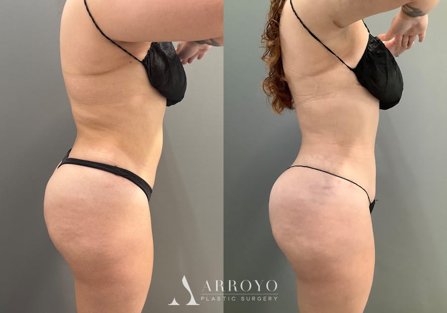 Liposuction Before & After Gallery - Patient 705659 - Image 3