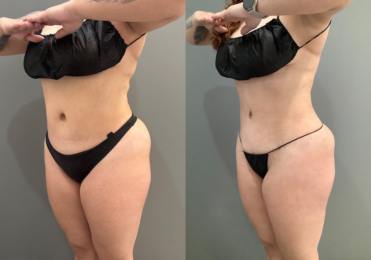 Liposuction Before & After Gallery - Patient 705659 - Image 4