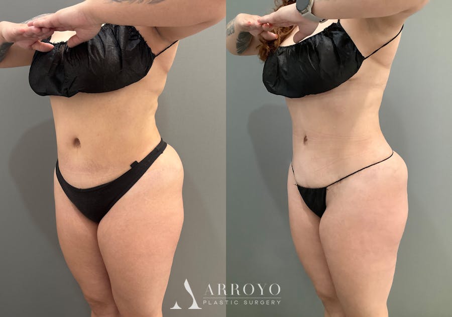 Liposuction Before & After Gallery - Patient 705659 - Image 4