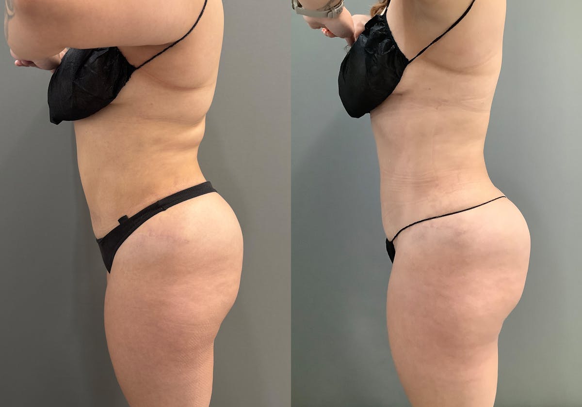 Liposuction Before & After Gallery - Patient 705659 - Image 5