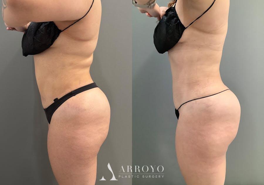 Liposuction Before & After Gallery - Patient 705659 - Image 5