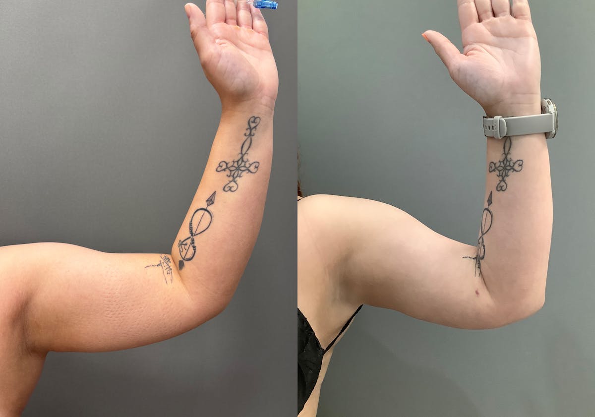 Liposuction Before & After Gallery - Patient 705659 - Image 7