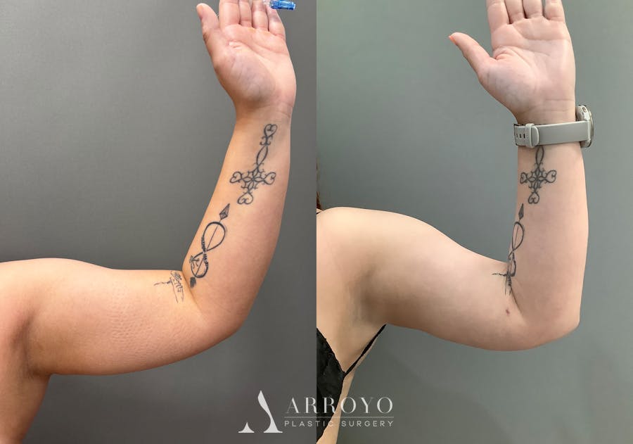 Liposuction Before & After Gallery - Patient 705659 - Image 7