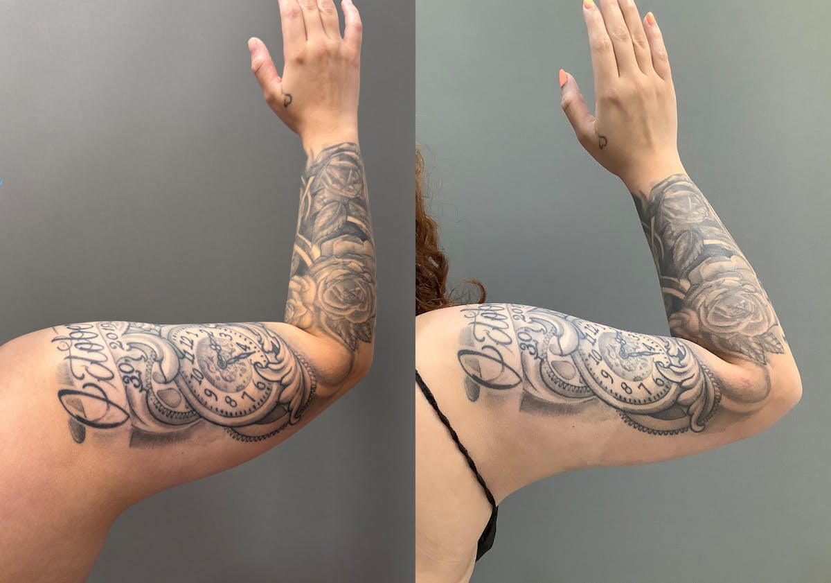 Liposuction Before & After Gallery - Patient 705659 - Image 6
