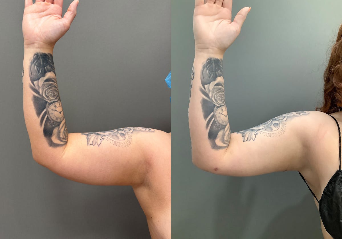 Liposuction Before & After Gallery - Patient 705659 - Image 8