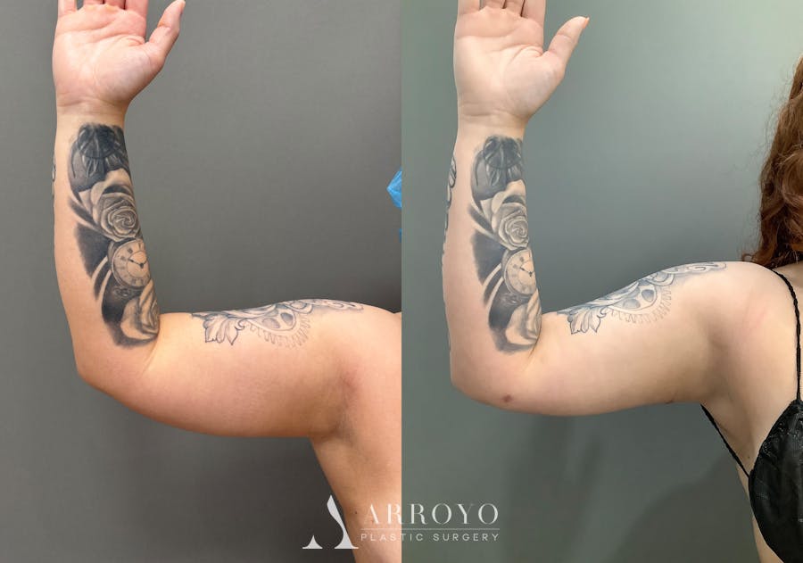 Liposuction Before & After Gallery - Patient 705659 - Image 8