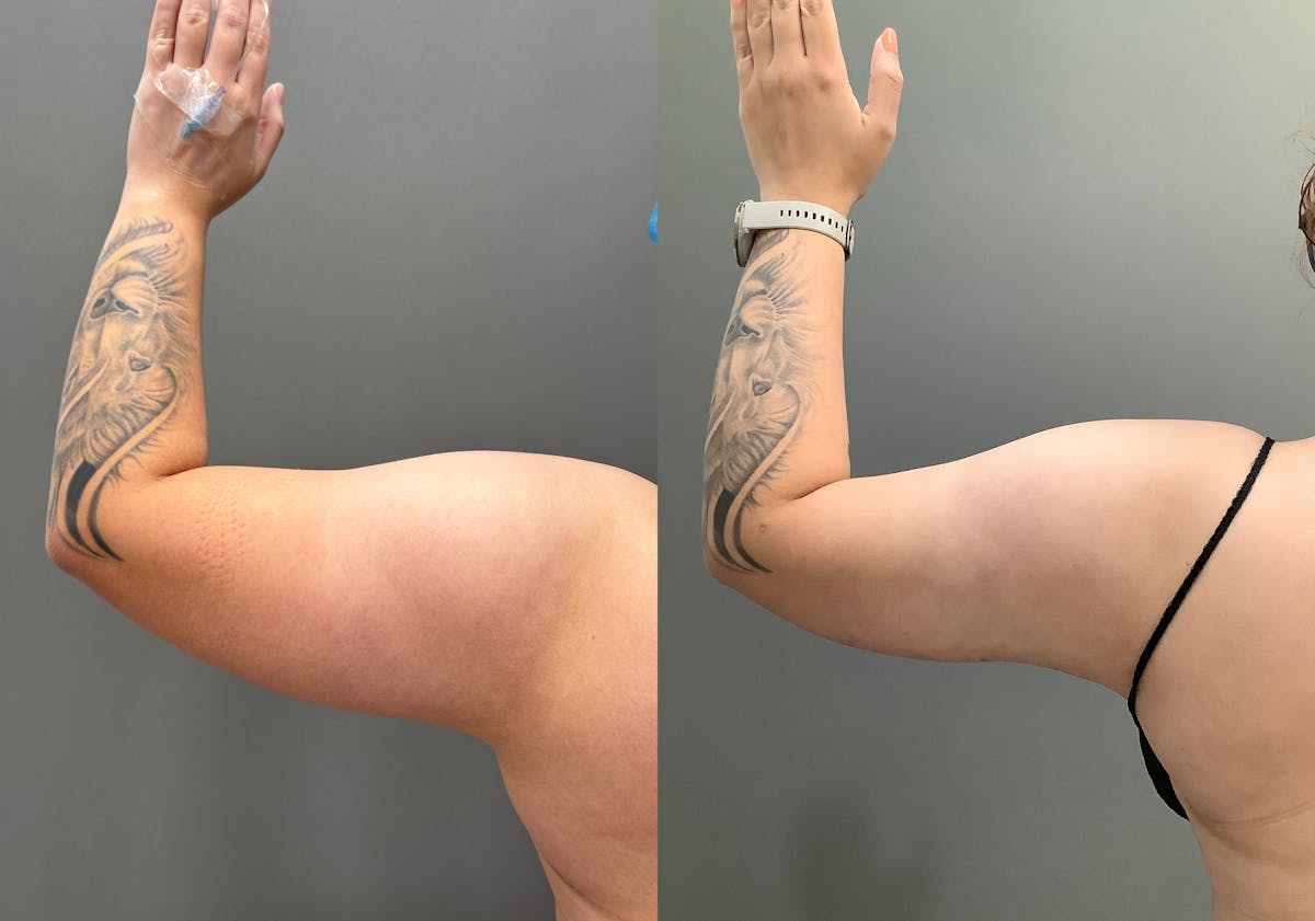 Liposuction Before & After Gallery - Patient 705659 - Image 9