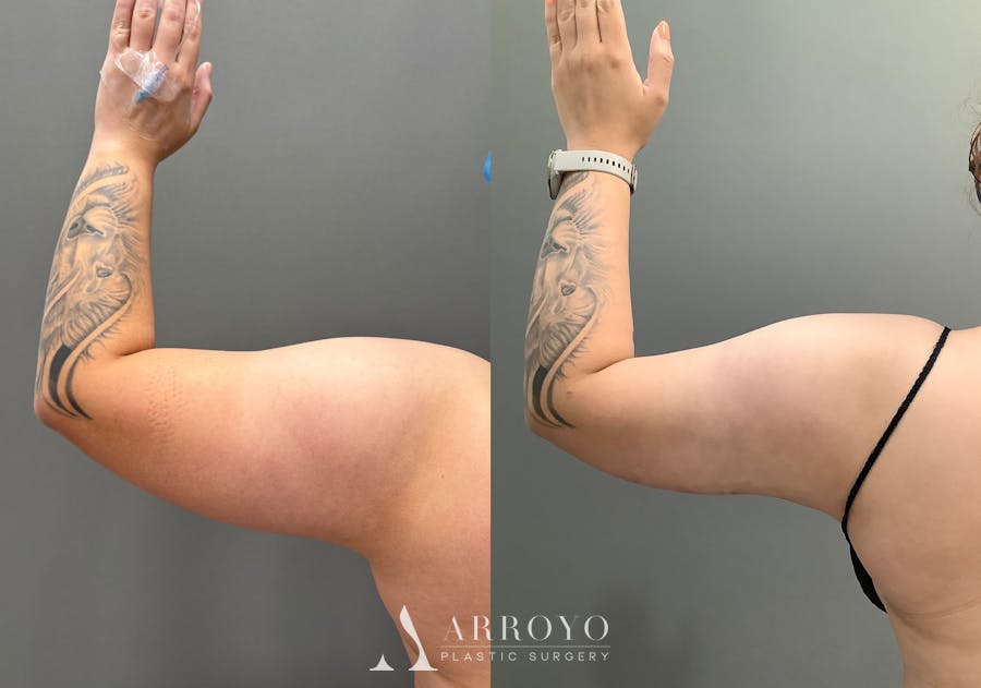 Liposuction Before & After Gallery - Patient 705659 - Image 9