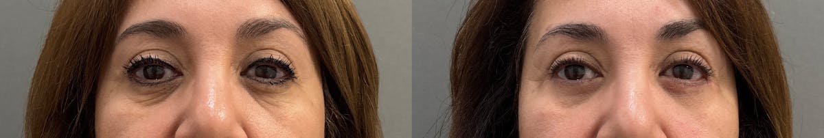 Blepharoplasty Before & After Gallery - Patient 245019 - Image 1