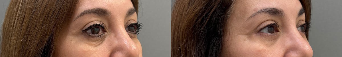 Blepharoplasty Before & After Gallery - Patient 245019 - Image 2