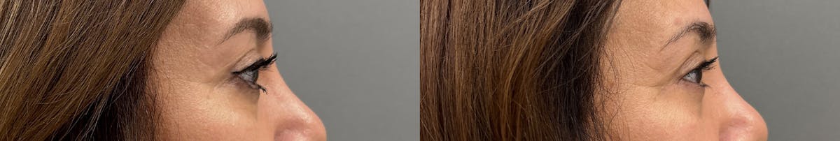 Blepharoplasty Before & After Gallery - Patient 245019 - Image 3