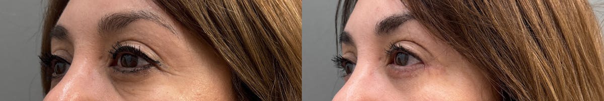 Blepharoplasty Before & After Gallery - Patient 245019 - Image 4