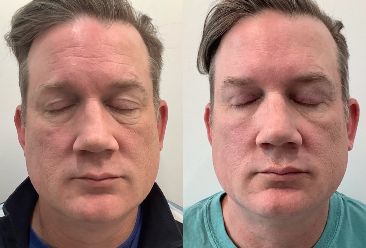 Blepharoplasty Before & After Gallery - Patient 258562 - Image 1