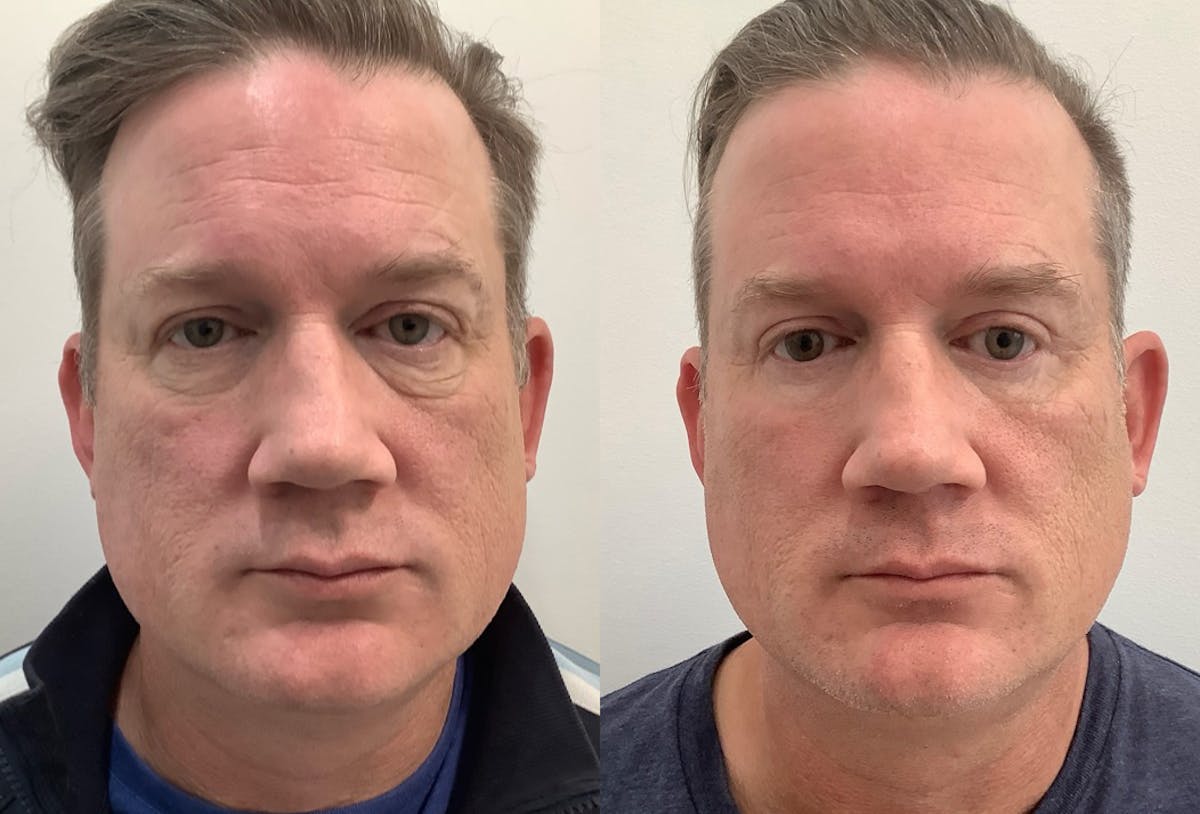 Blepharoplasty Before & After Gallery - Patient 258562 - Image 2