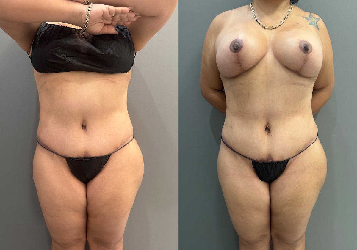 Liposuction Before & After Gallery - Patient 731636 - Image 1
