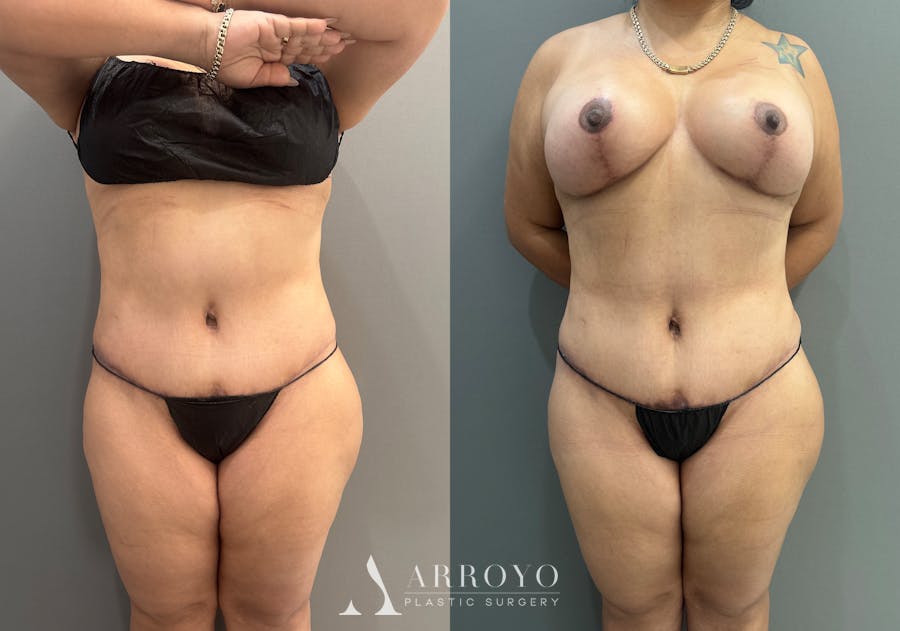Tummy Tuck Before & After Gallery - Patient 404462 - Image 1