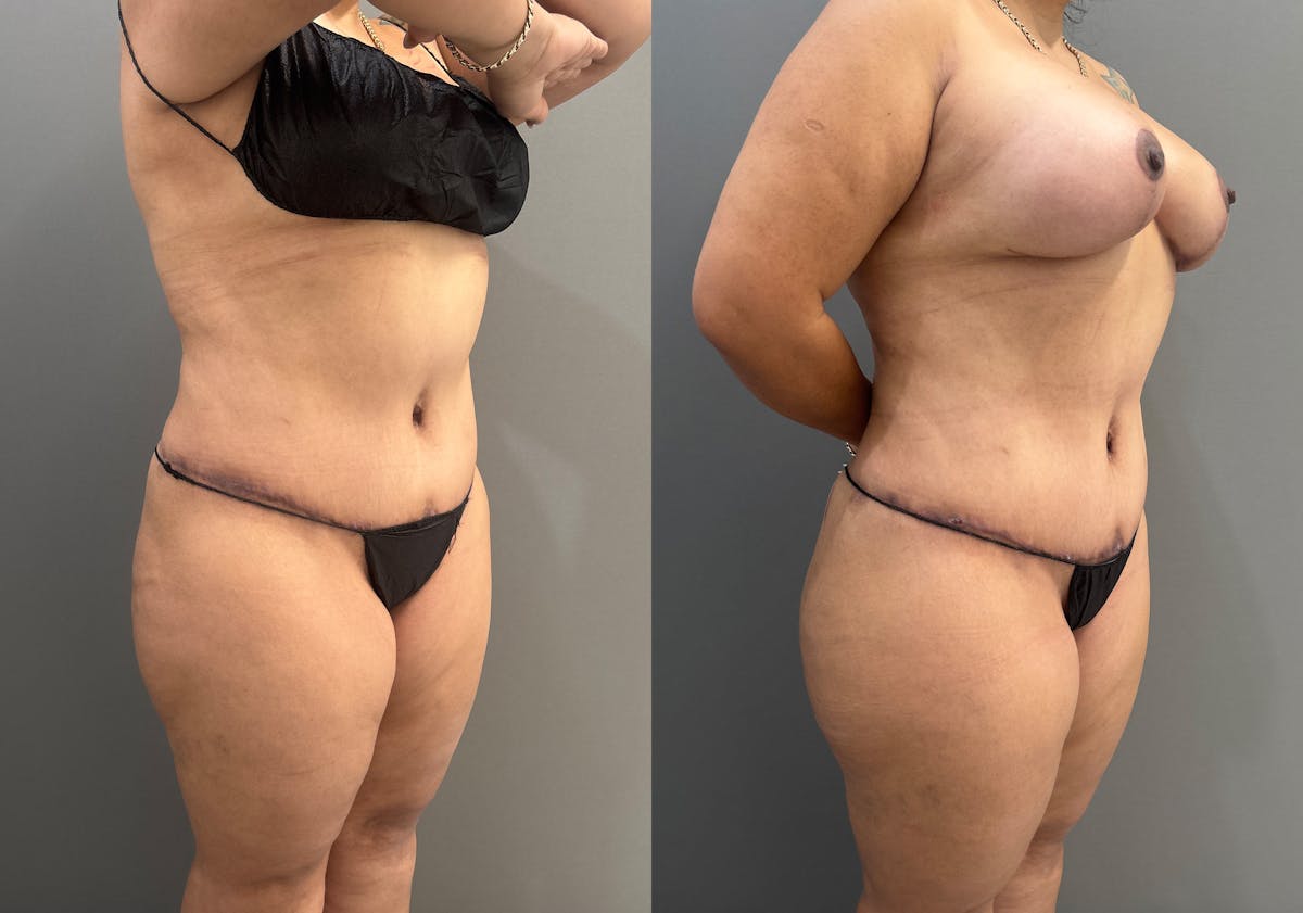 Liposuction Before & After Gallery - Patient 731636 - Image 2