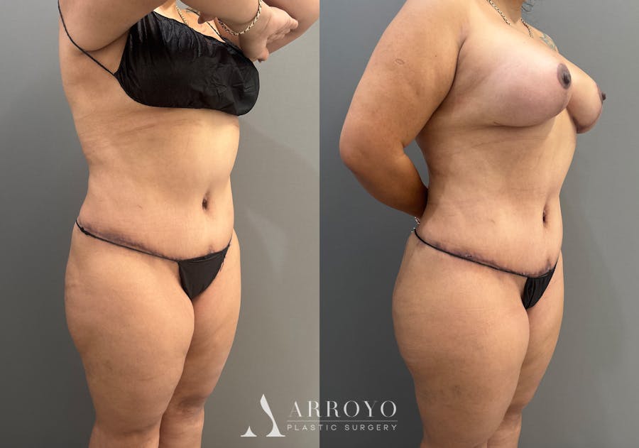 Tummy Tuck Before & After Gallery - Patient 404462 - Image 2