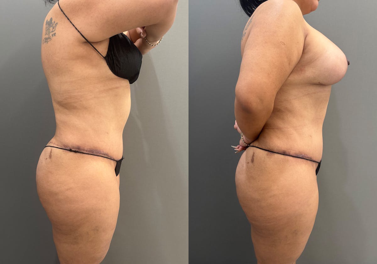 Liposuction Before & After Gallery - Patient 731636 - Image 3