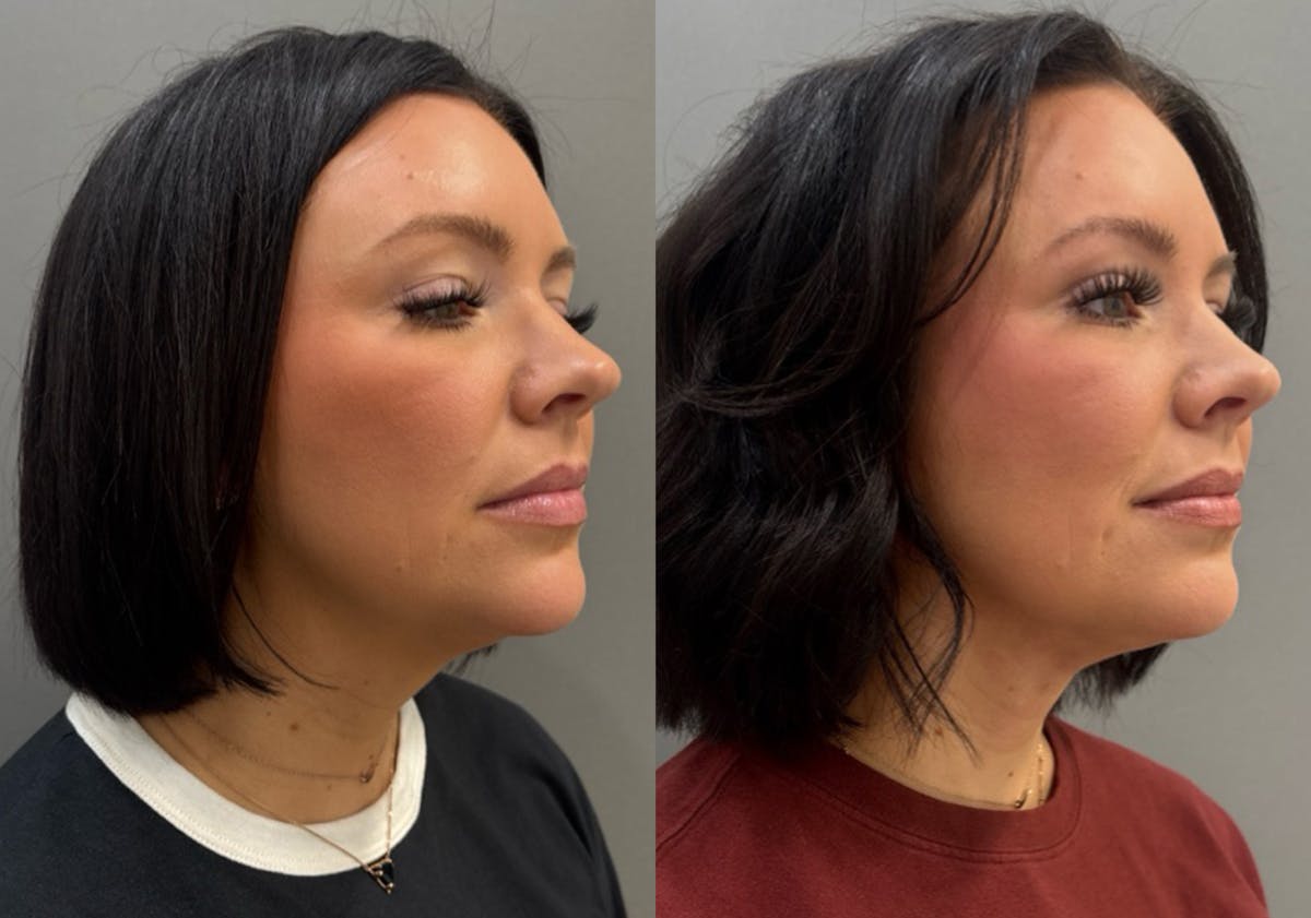 Facetite Before & After Gallery - Patient 310256 - Image 4