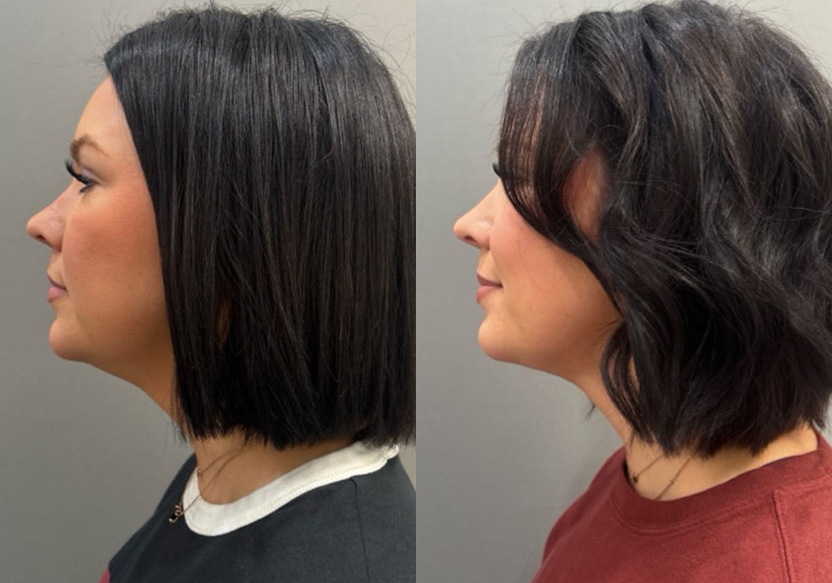 Facetite Before & After Gallery - Patient 310256 - Image 1
