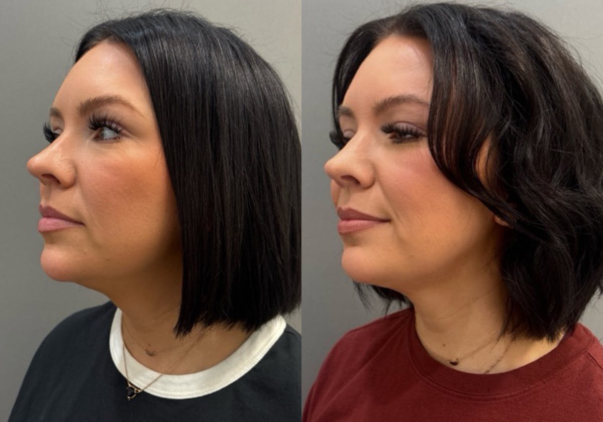 Facetite Before & After Gallery - Patient 310256 - Image 2