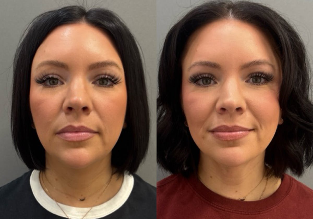 Facetite Before & After Gallery - Patient 310256 - Image 3