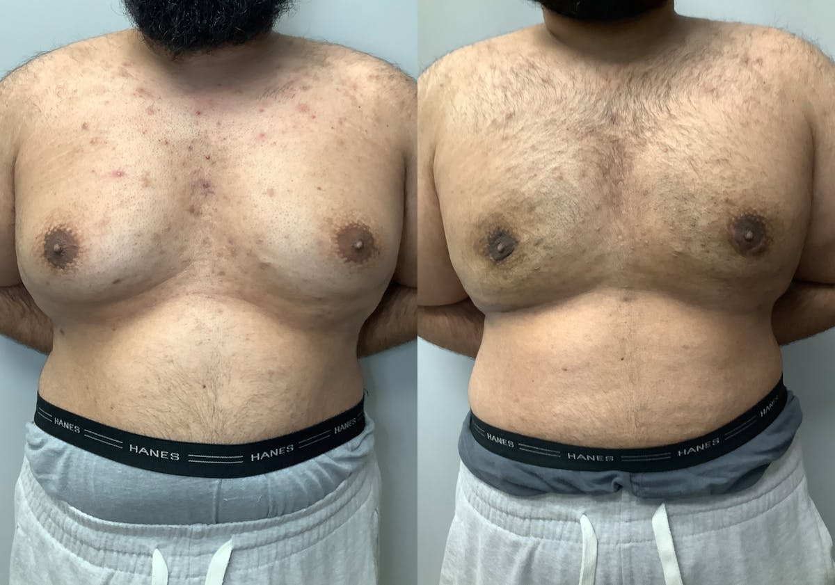Gynecomastia Before & After Gallery - Patient 426074 - Image 1