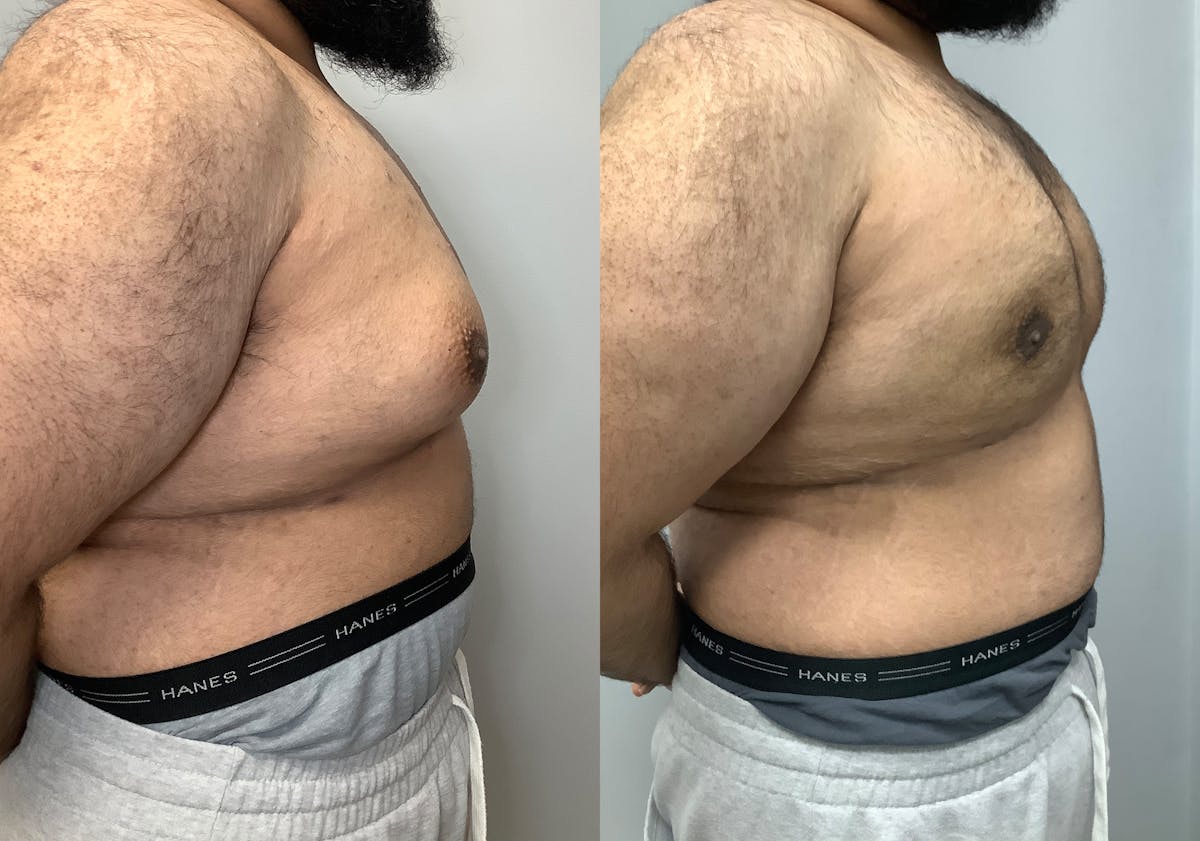 Gynecomastia Before & After Gallery - Patient 426074 - Image 2