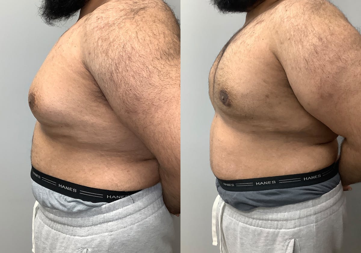 Gynecomastia Before & After Gallery - Patient 426074 - Image 3
