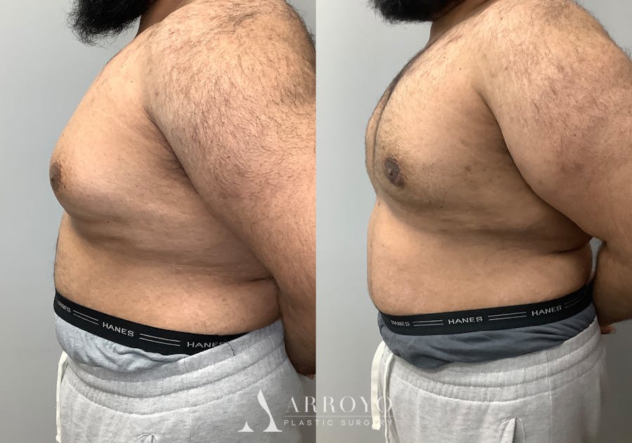 Gynecomastia Before & After Gallery - Patient 426074 - Image 3
