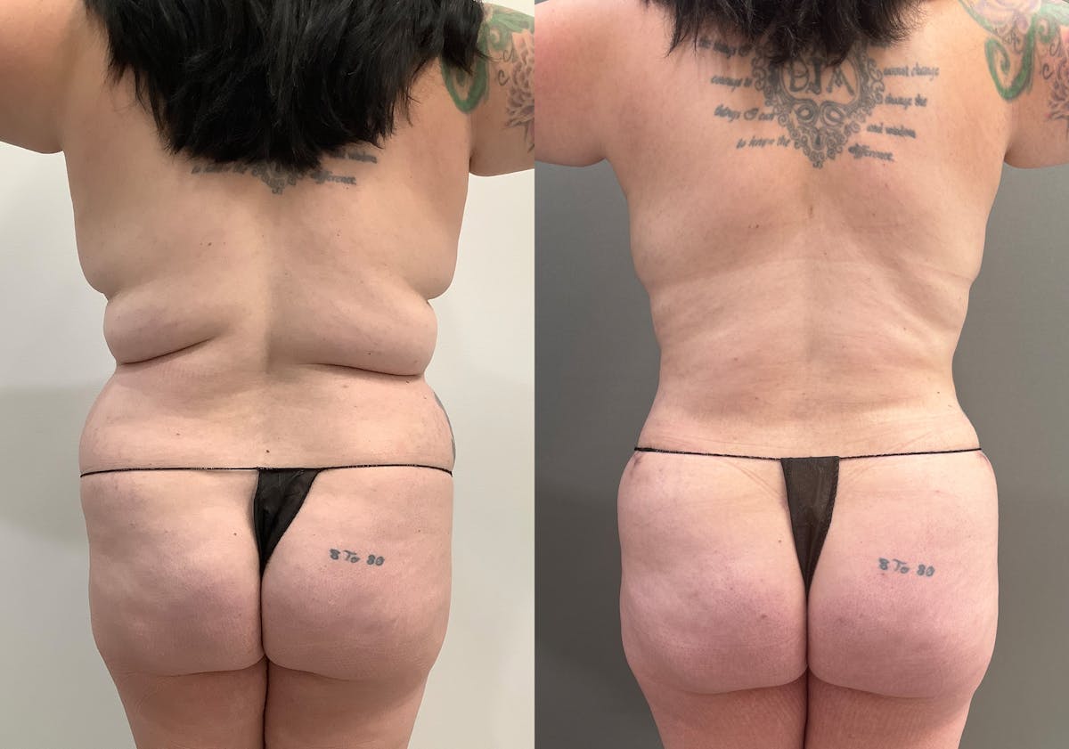 Breast Reduction Before & After Gallery - Patient 965073 - Image 5