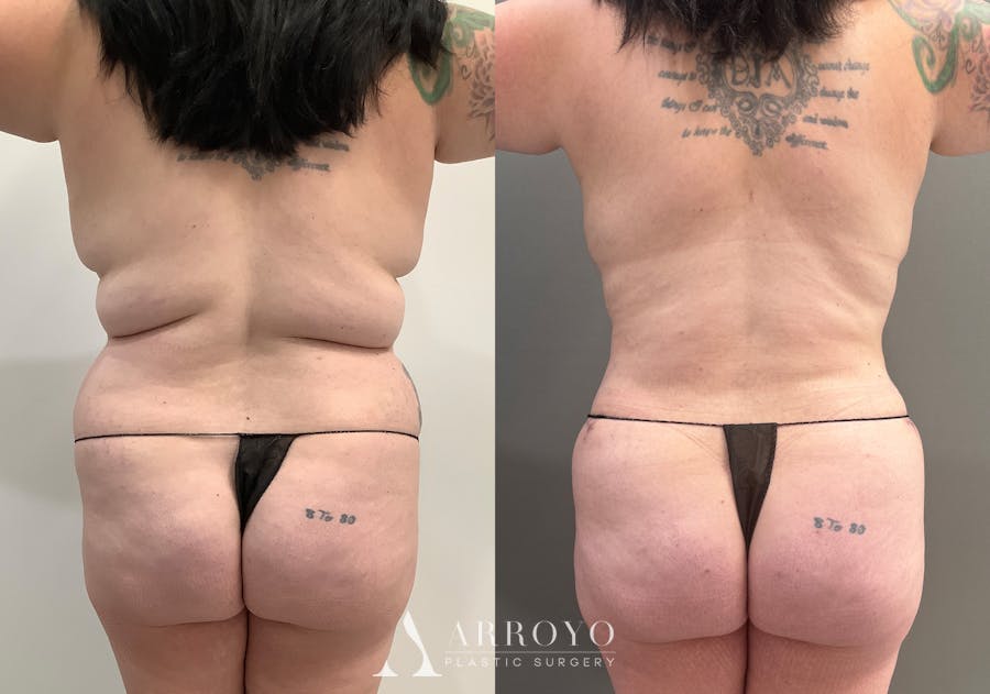 Tummy Tuck Before & After Gallery - Patient 528060 - Image 5