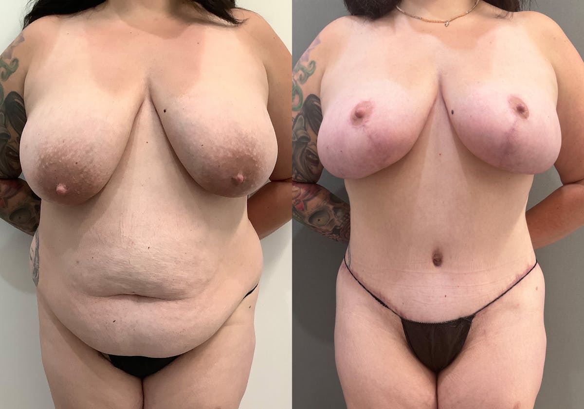 Breast Reduction Before & After Gallery - Patient 965073 - Image 1