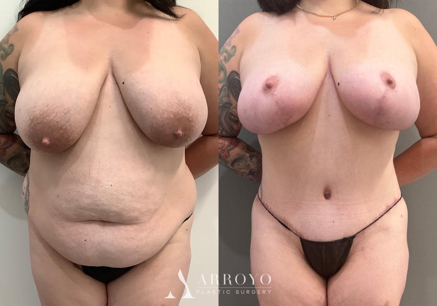 Tummy Tuck Before & After Gallery - Patient 528060 - Image 1