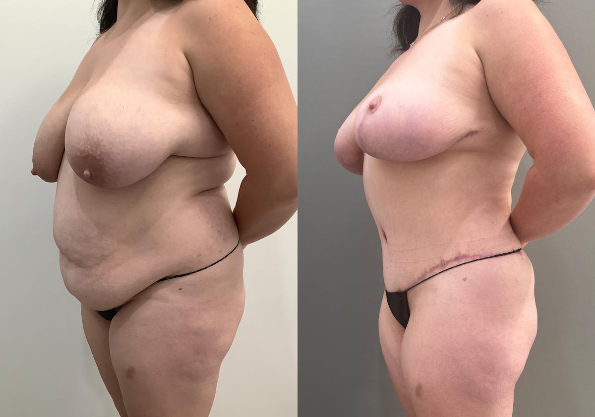 Breast Reduction Before & After Gallery - Patient 965073 - Image 2