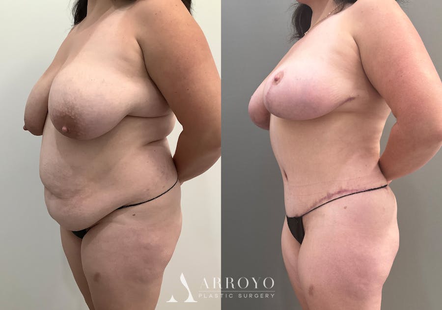 Tummy Tuck Before & After Gallery - Patient 528060 - Image 2