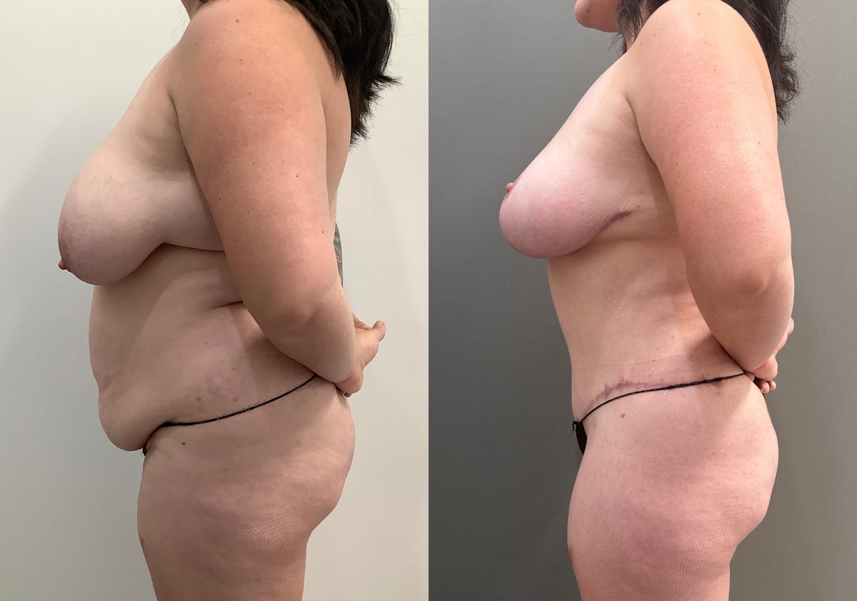 Breast Reduction Before & After Gallery - Patient 965073 - Image 3