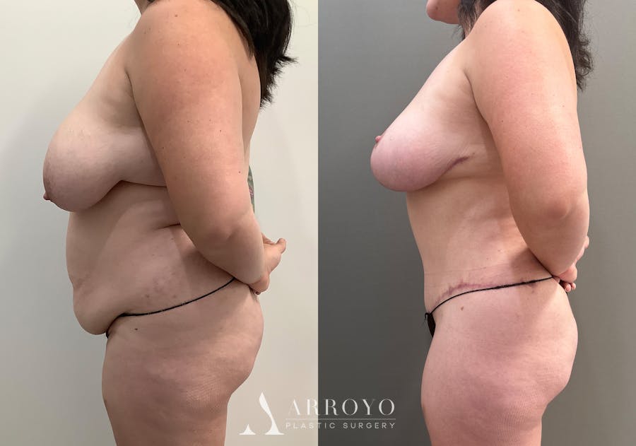 Tummy Tuck Before & After Gallery - Patient 528060 - Image 3