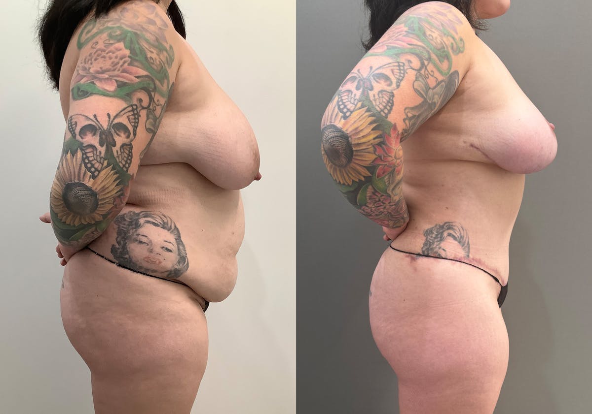 Breast Reduction Before & After Gallery - Patient 965073 - Image 4