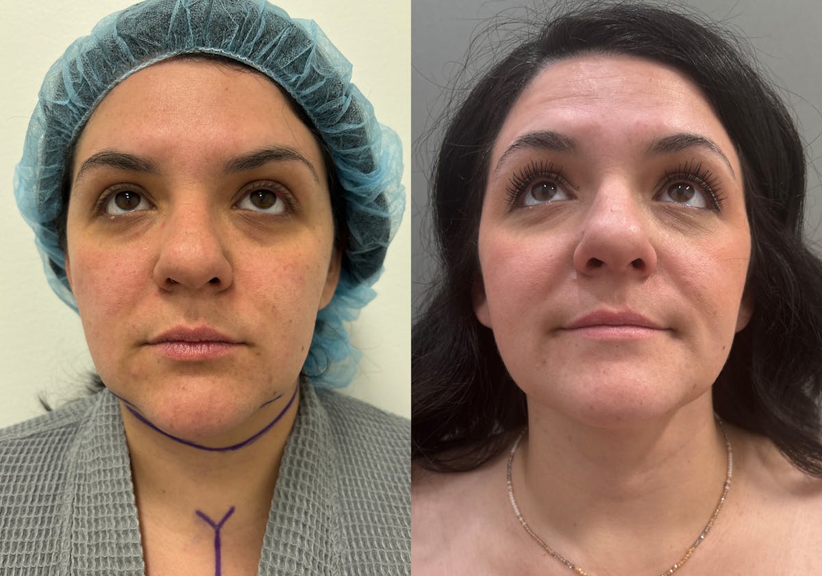 Neck Liposuction Before & After Gallery - Patient 542043 - Image 3