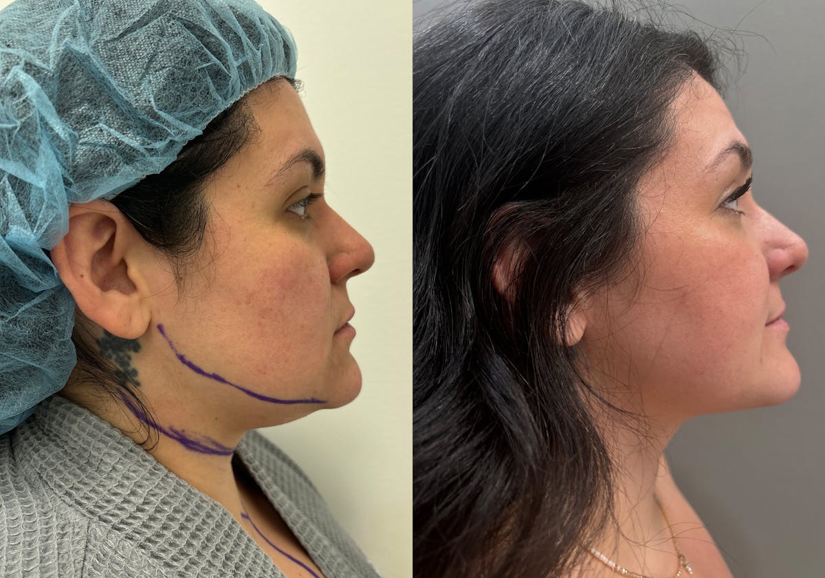 Neck Liposuction Before & After Gallery - Patient 542043 - Image 1