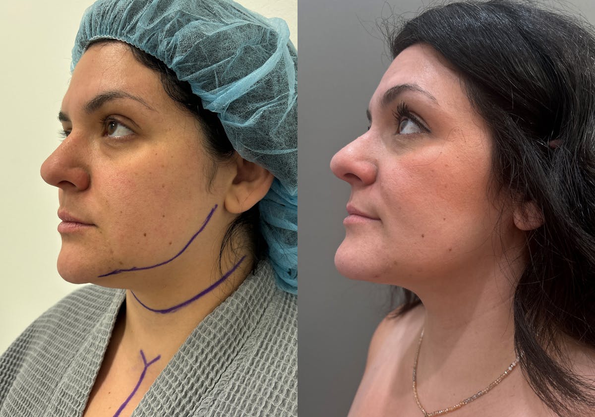 Neck Liposuction Before & After Gallery - Patient 542043 - Image 2