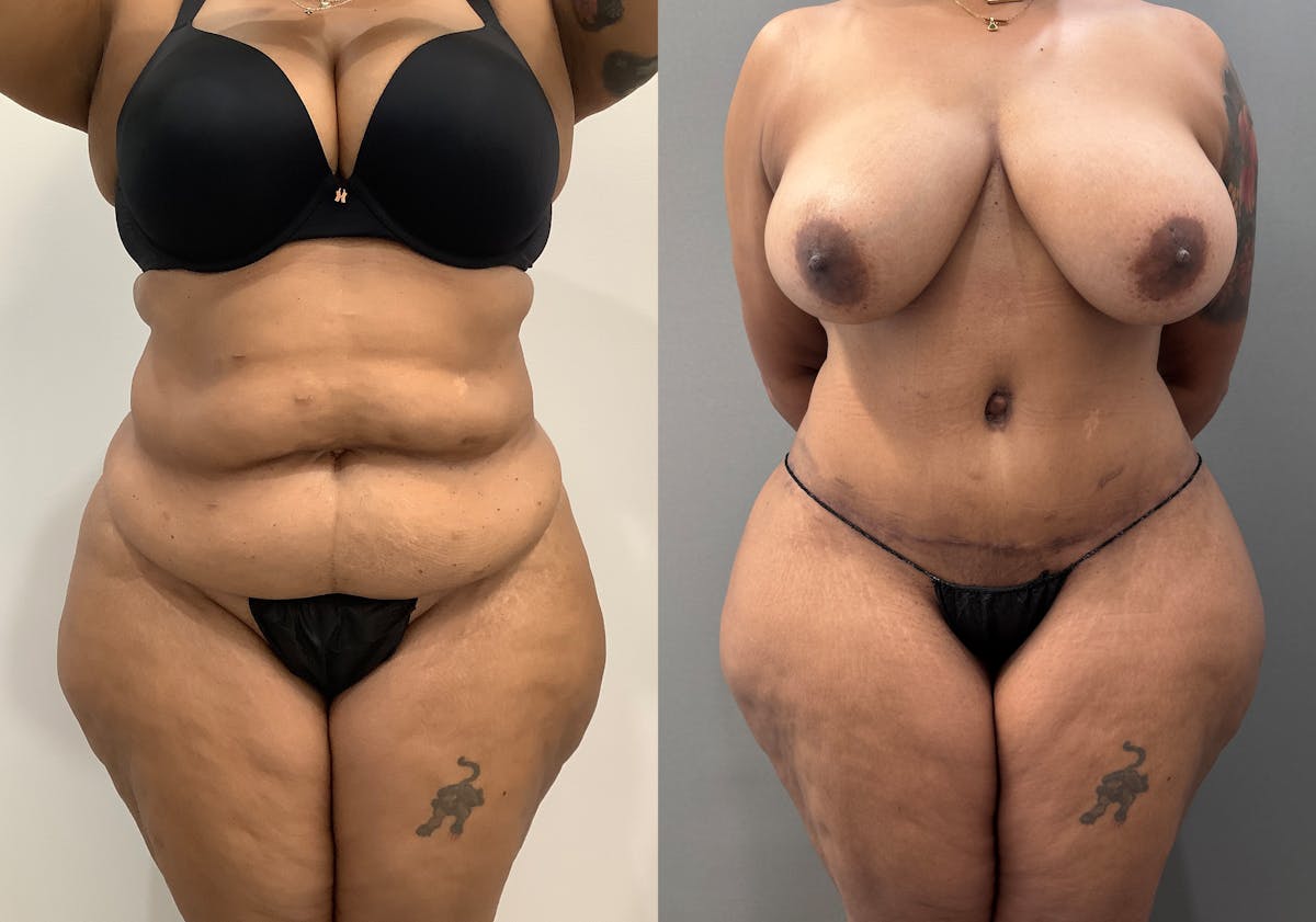 Liposuction Before & After Gallery - Patient 262528 - Image 1