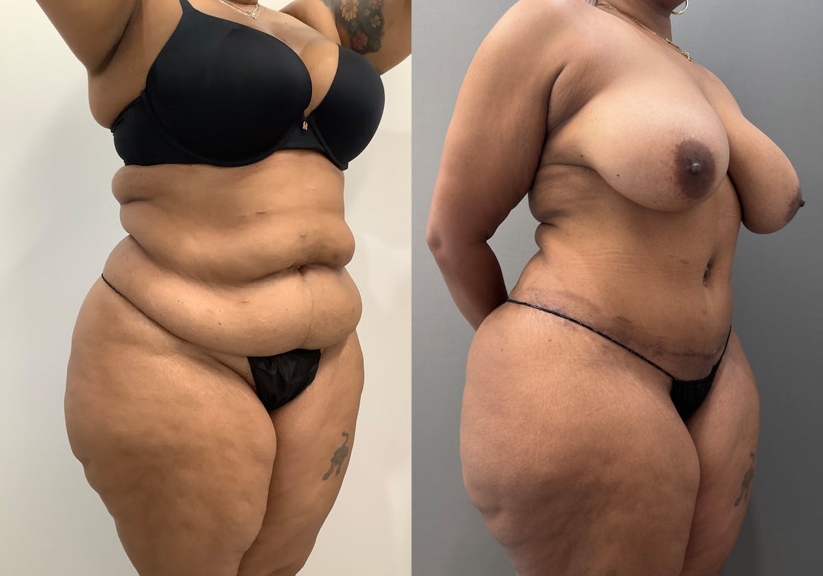 Liposuction Before & After Gallery - Patient 262528 - Image 2