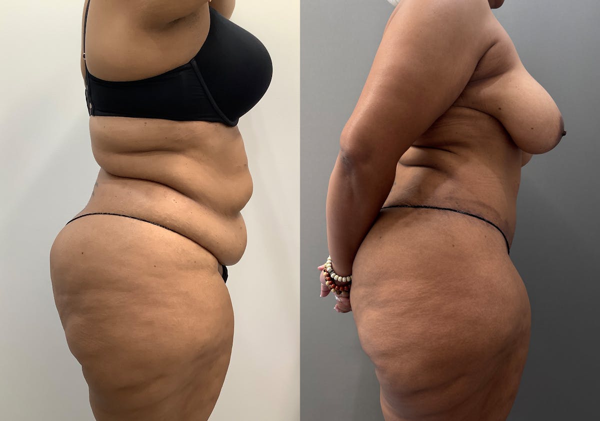 Liposuction Before & After Gallery - Patient 262528 - Image 3