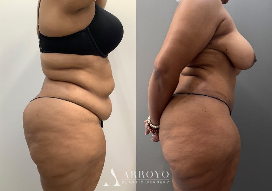 Tummy Tuck Before & After Gallery - Patient 706397 - Image 3
