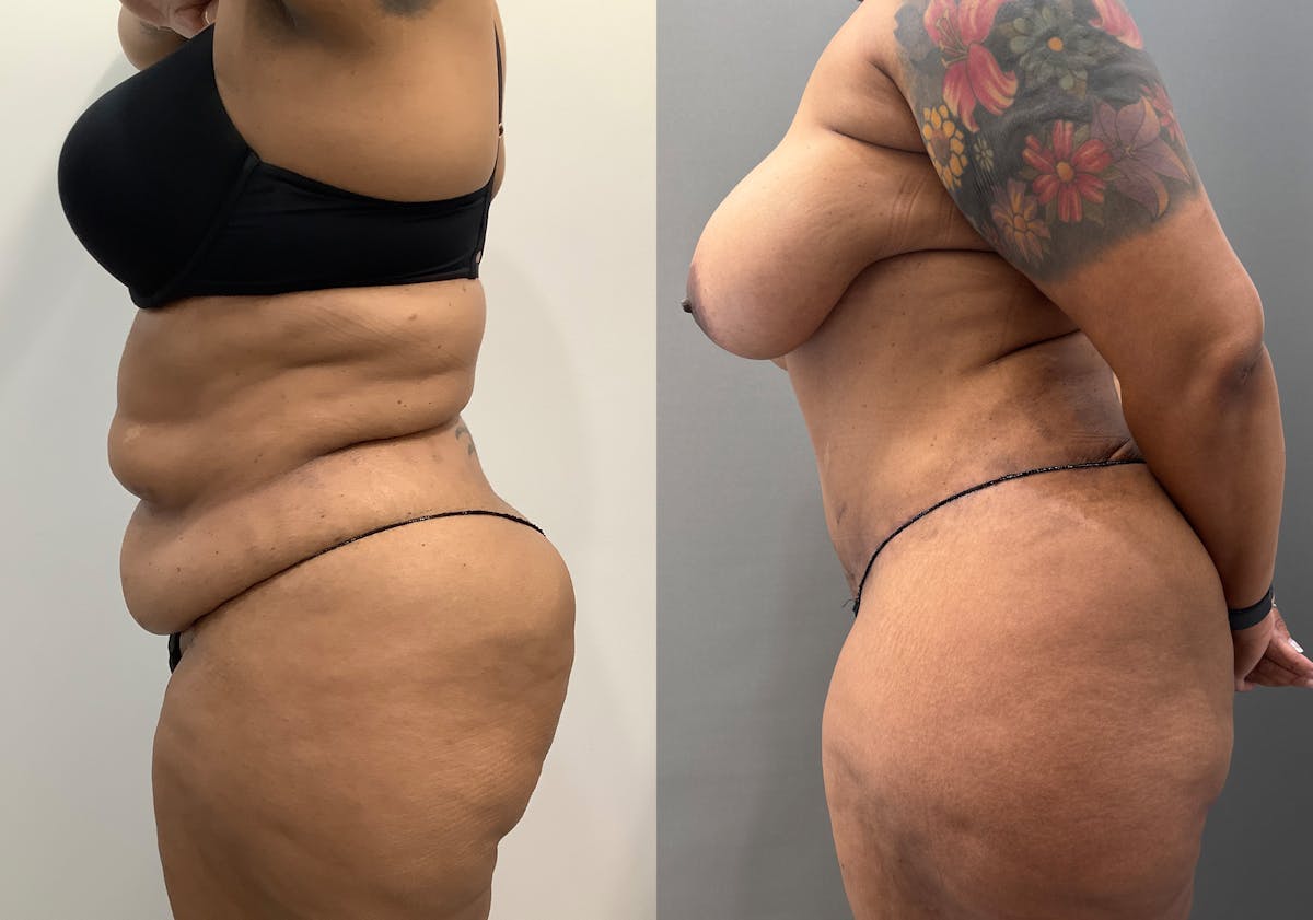 Liposuction Before & After Gallery - Patient 262528 - Image 4