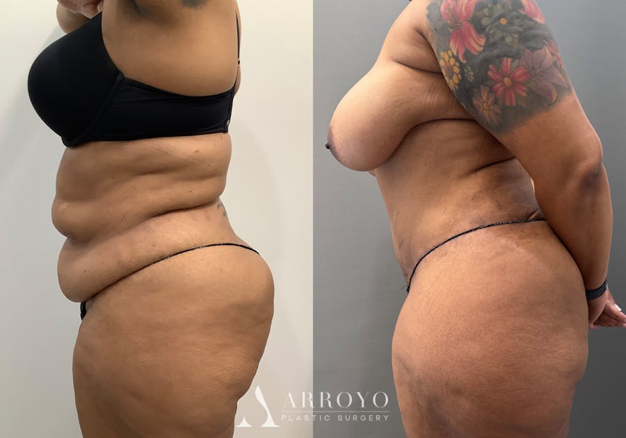 Tummy Tuck Before & After Gallery - Patient 706397 - Image 4